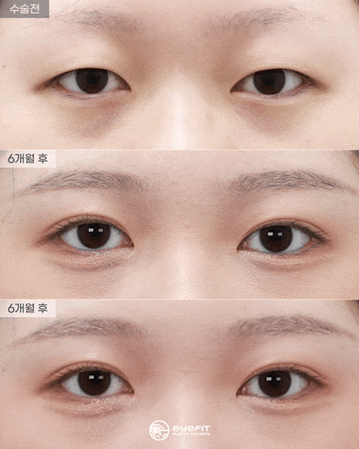 Natural Adhesion: Before and 6 Months After [Eyefit Plastic Surgery] image 2
