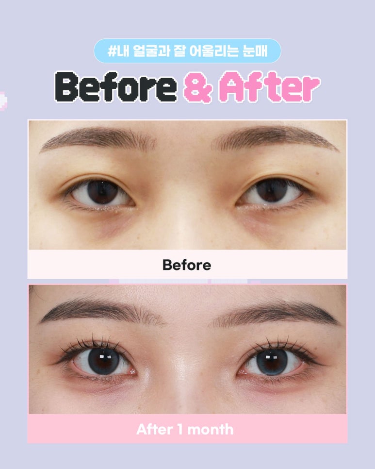Eyefit Plastic Surgery 2026 Exam-Taker Eye Surgery Discount Event🌟 image 3