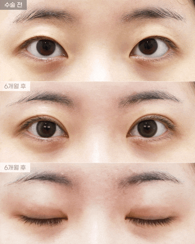 [Eyefit Plastic Surgery] Natural Adhesion + Upper Eye Corner Revision Before-and-After Real Video🩵 image 2