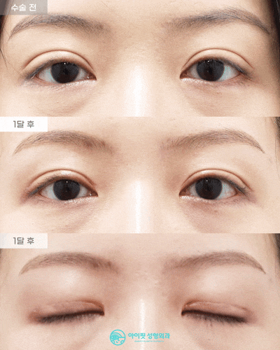 [Eyefit Plastic Surgery] Sausage Eye Revision Surgery Real Video 🩵 image 1