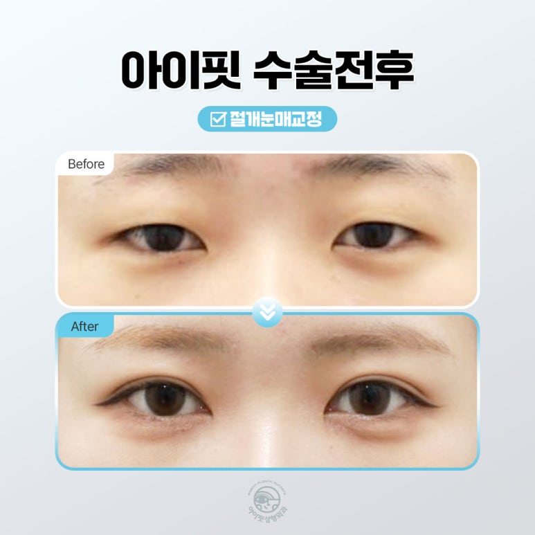 [Eyefit Plastic Surgery] When the eyes lack the strength to open, make them clearer with eye correction image 3
