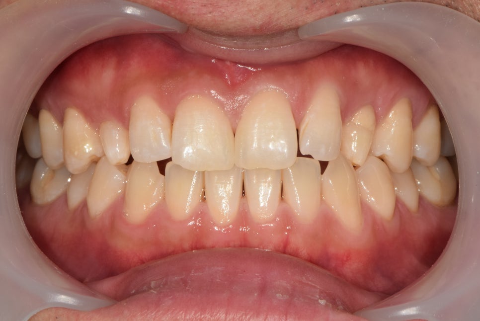 약수역 라미네이트 치과 선천적 왜소치 무삭제 치아 복원 관련 이미지 2