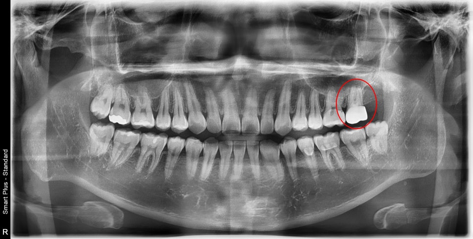 장충동 치과, MTA를 이용한 신경치료 시 주의할 점( 크랙치아, 깊은 충치) 관련 이미지 3