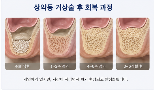 Yak-su Station Dental Clinic: When Is a Sinus Lift Necessary for Implants? image 7