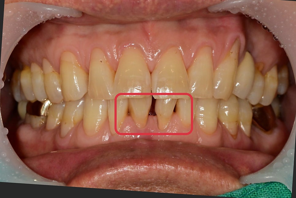 성동구 옥수동 치과 앞니 임플란트수술 즉시 임시치아 제작(구강스캐너를 이용한 수술절차) 관련 이미지 1