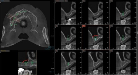 금호역 치과, 전체 틀니 대신 전체 임플란트로 가는 기간(식립위치의 선정의 중요성) 관련 이미지 3