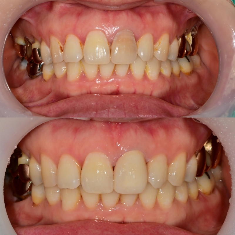 신당동 앞니 변색 치아 크라운치료 바른영치과 심미보철 케이스 관련 이미지 6