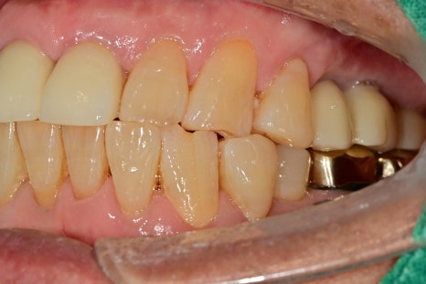 약수 임플란트, 씹을 때 갑작스러운 통증의 원인은? 관련 이미지 8