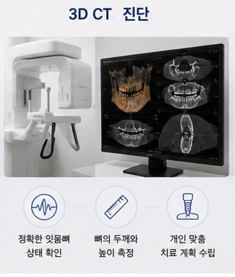 약수역 임플란트, 뼈이식 없이 가능한 경우도 있을까요? 관련 이미지 4