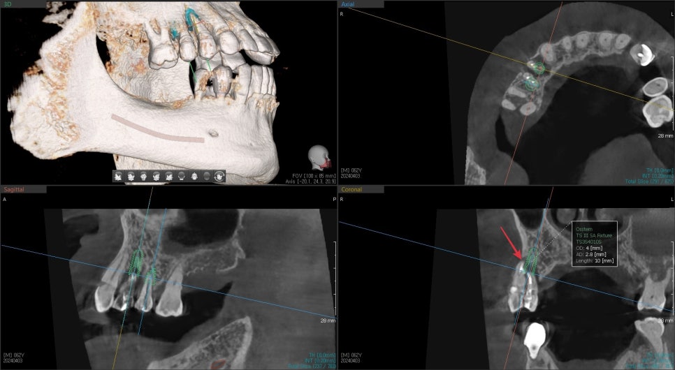 금호동 치과 신경치료된 치아 주변 염증 방치하면 안 되는 이유(발치후 임플란트) 관련 이미지 2
