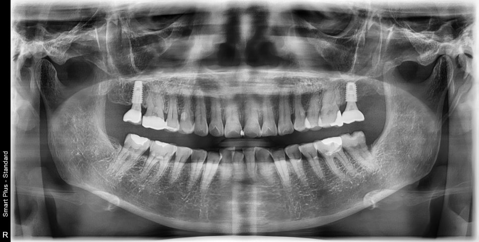 약수역 치과, 신경치료된 치아 뿌리 주변 염증이 생겼을 때 발치 후 발치와 보존술 처치( 임플란트 식립을 위한 치료 ) 관련 이미지 5