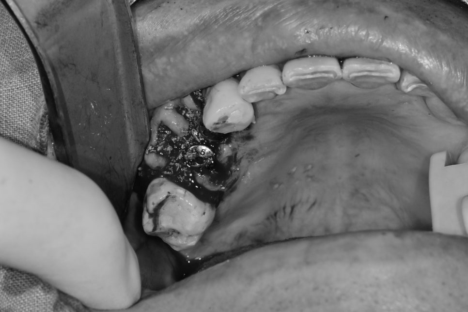 금호동 치과 신경치료된 치아 주변 염증 방치하면 안 되는 이유(발치후 임플란트) 관련 이미지 3