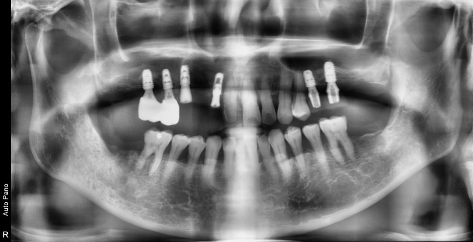 신당역 임플란트 풍치, 심한 치주염인 경우 치과에서 치료 순서 관련 이미지 10