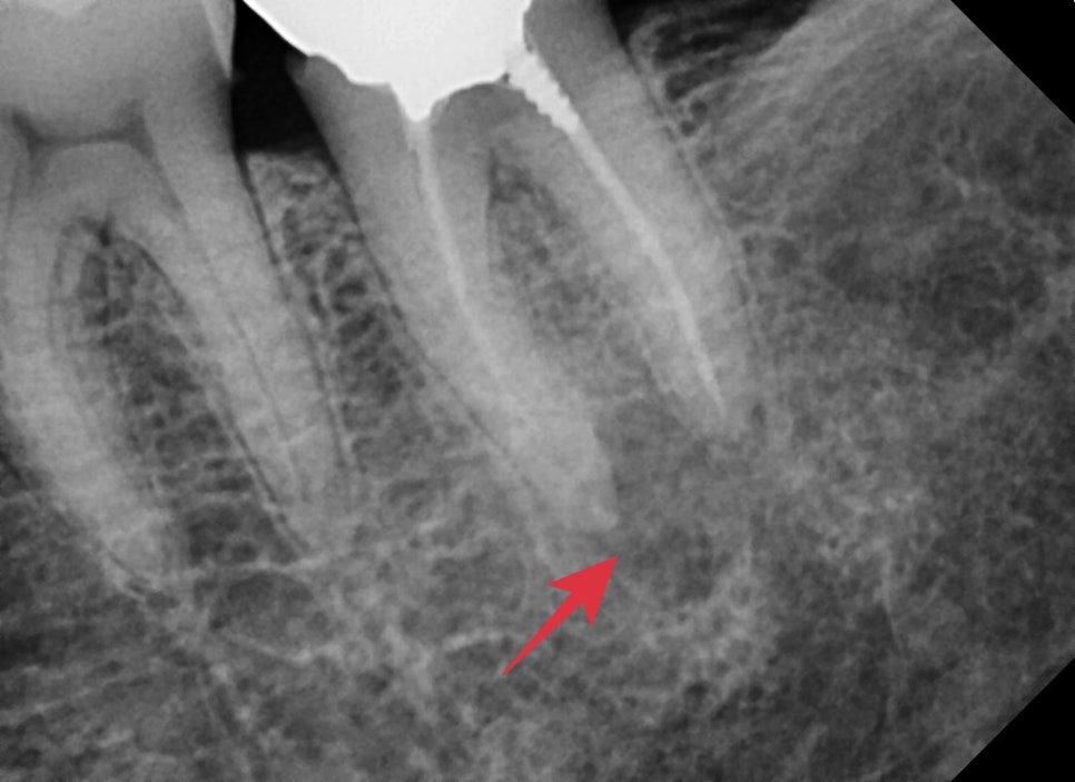 옥수동 크라운치료된 통증 있는 치아의 (재)신경치료 과정 관련 이미지 9