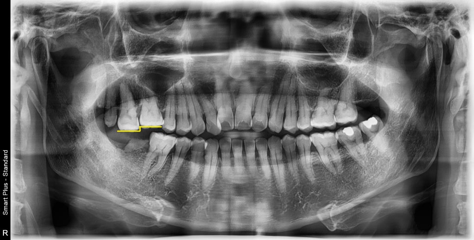 신당동주변치과 치아가 오랜 시간 없을 경우 주변 치아에 미치는 영향 관련 이미지 1