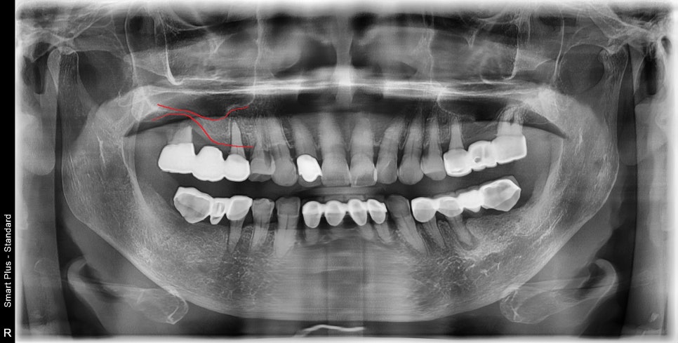 약수역 치과, 임플란트는 치아 개수마다 꼭 필요한가요?( 임플란트 진단이 모두 다른 이유??) 관련 이미지 1