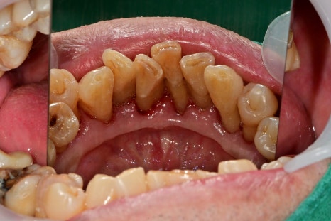 청구역 치과 치주염으로 다수의 치아가 흔들리는 경우(발치, 임플란트) 관련 이미지 5