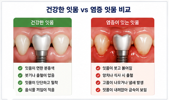 Yaksu Station Dental Clinic: Can Gum Disease Develop Around Implants, Too? image 4