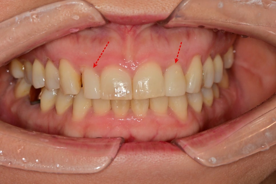 동대입구역 주변 치과 라미네이트가 깨지는 이유 관련 이미지 1