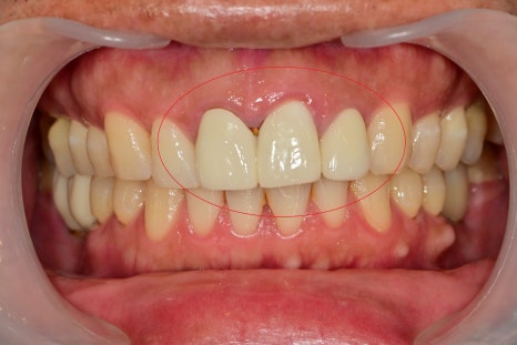 약수역 치과 , 전치부 심미보철 재제작할때 주의할 점 ( 항상 무삭제 라미네이트가 가능한 것인가??) 관련 이미지 2