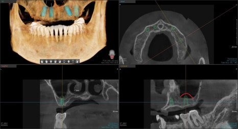 금호역 치과, 전체 틀니 대신 전체 임플란트로 가는 기간(식립위치의 선정의 중요성) 관련 이미지 2