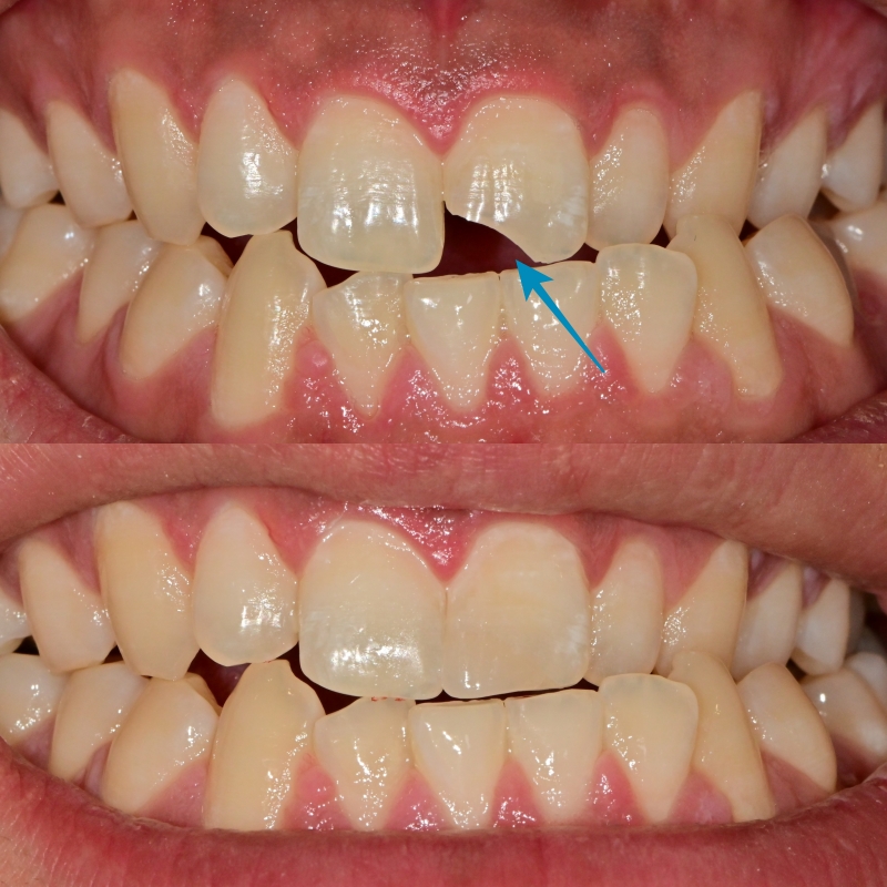 동대입구 주변 치과 앞니 깨졌을 때 치아삭제 없이 치료 관련 이미지 2