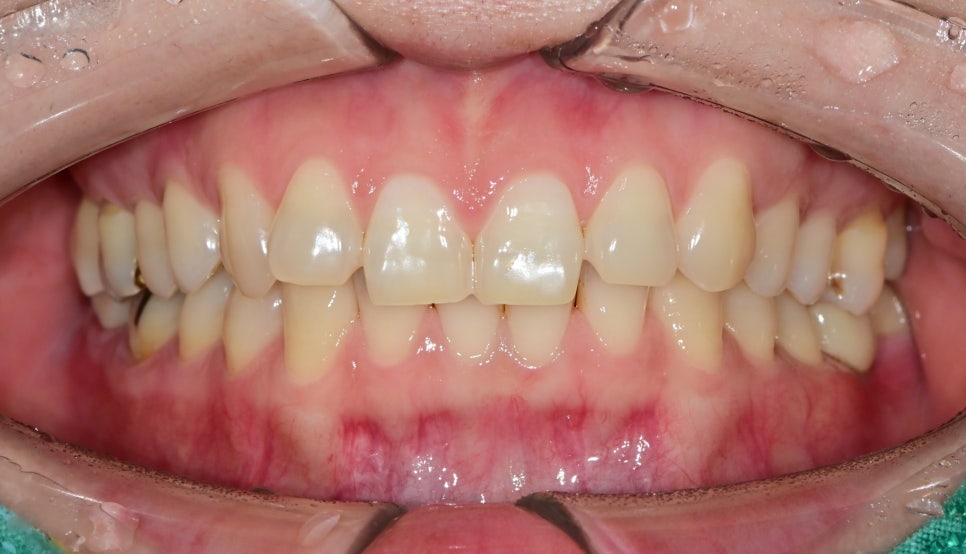 신당 라미네이트 치과 미세삭제로 예쁜 미소 만들기 관련 이미지 1