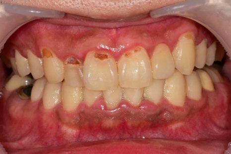 금남시장 치과, 잇몸염증이 생긴다면 원인과 치료 방법은?? ( 양치할 때 피나요, 치아색이 이상해요) 관련 이미지 8