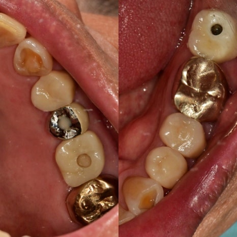 버티고개역 치과 깨지고 닳은 치아 회복하는 방법 관련 이미지 6
