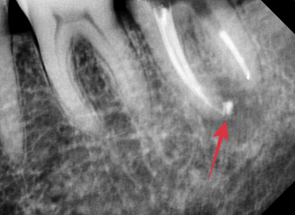옥수동 크라운치료된 통증 있는 치아의 (재)신경치료 과정 관련 이미지 11