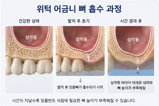 Yak-su Station Dental Clinic: When Is a Sinus Lift Necessary for Implants? image 2
