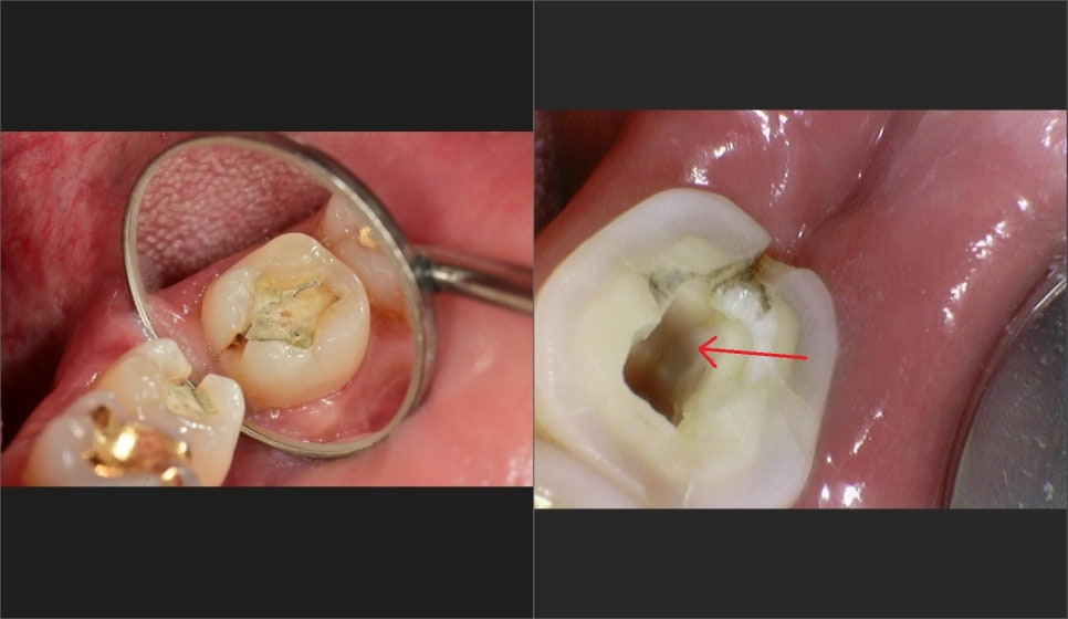 약수역 치과, 어려운 신경형태의 치아 신경치료 할때 주의할점 ( C형 근관, 신경관 찾기, 치아보존치료) 관련 이미지 4
