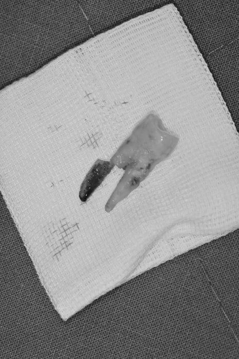 신당동 치과 씹을 때마다 아플 때 임플란트 치아의 문제 관련 이미지 4