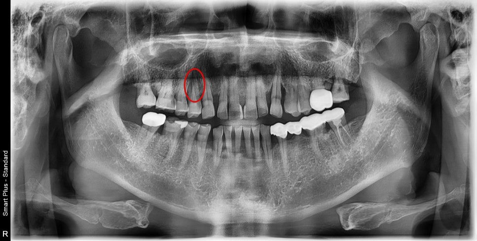 신당동 치과 씹을 때마다 아플 때 임플란트 치아의 문제 관련 이미지 1
