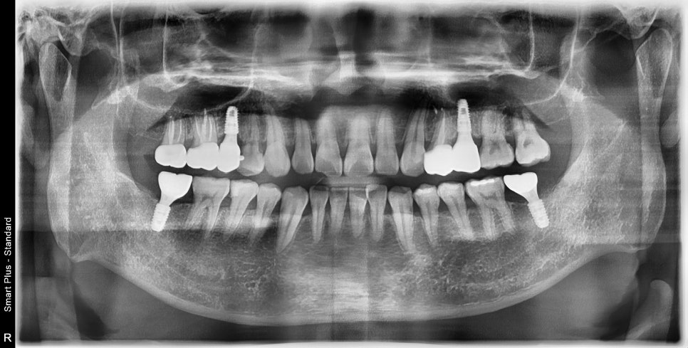 장충동 주변 치과 오래된 충치, 빠진 치아 부위 치료 방법 관련 이미지 6