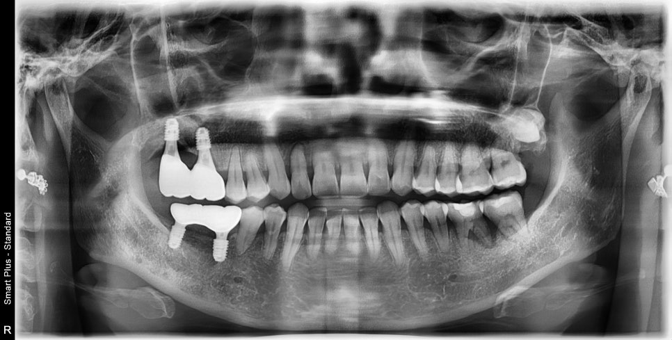 약수동 임플란트 염증으로 인한 발치 후 임플란트 식립( 상악동 거상술) 관련 이미지 6