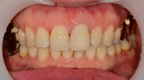 신당동 앞니 변색 치아 크라운치료 바른영치과 심미보철 케이스 관련 이미지 5