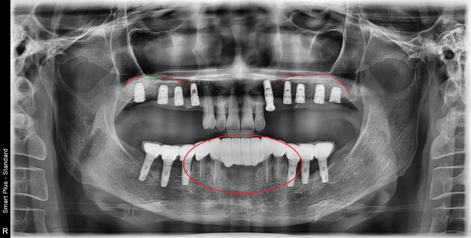 신당 임플란트, 심을까 말까 고민되신다면?? (고난도 골이식 임플란트 기간 및 통증) 관련 이미지 10