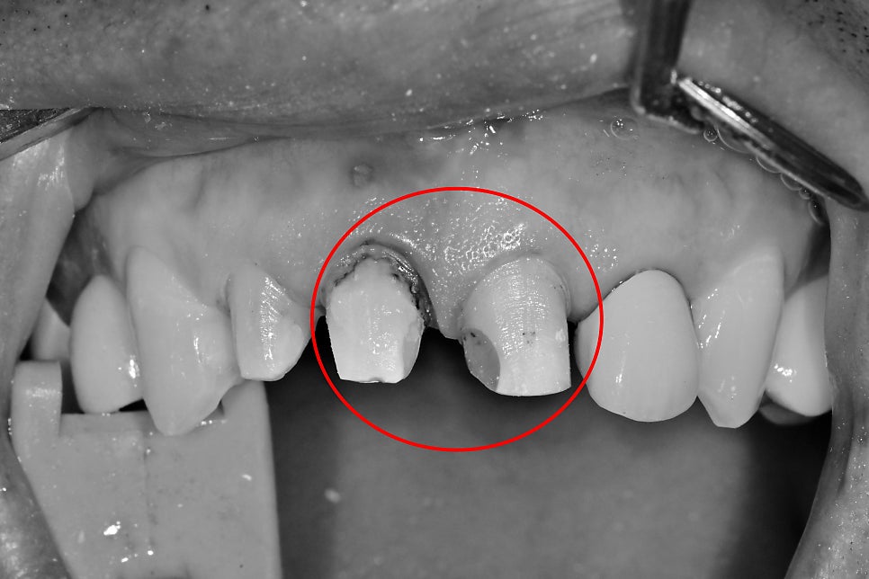 신당동 치과, 앞니 보철치료시 주의할 점(심미보철, 신경치료) 관련 이미지 5