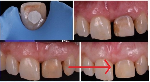신당동 앞니 변색 치아 크라운치료 바른영치과 심미보철 케이스 관련 이미지 3