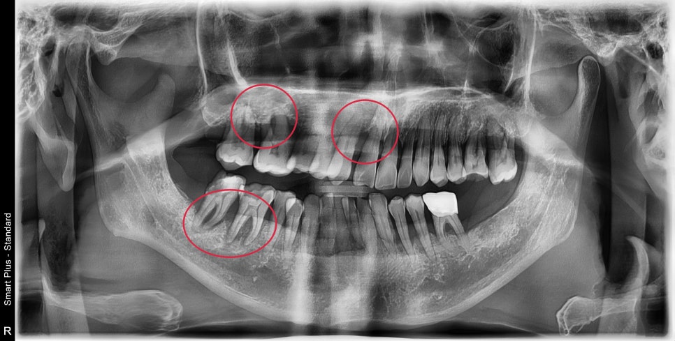 청구역 치과 치주염으로 다수의 치아가 흔들리는 경우(발치, 임플란트) 관련 이미지 1