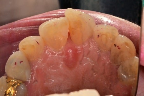 신당동치과 심미보철을 이용한 고른 앞니 만들기 관련 이미지 2