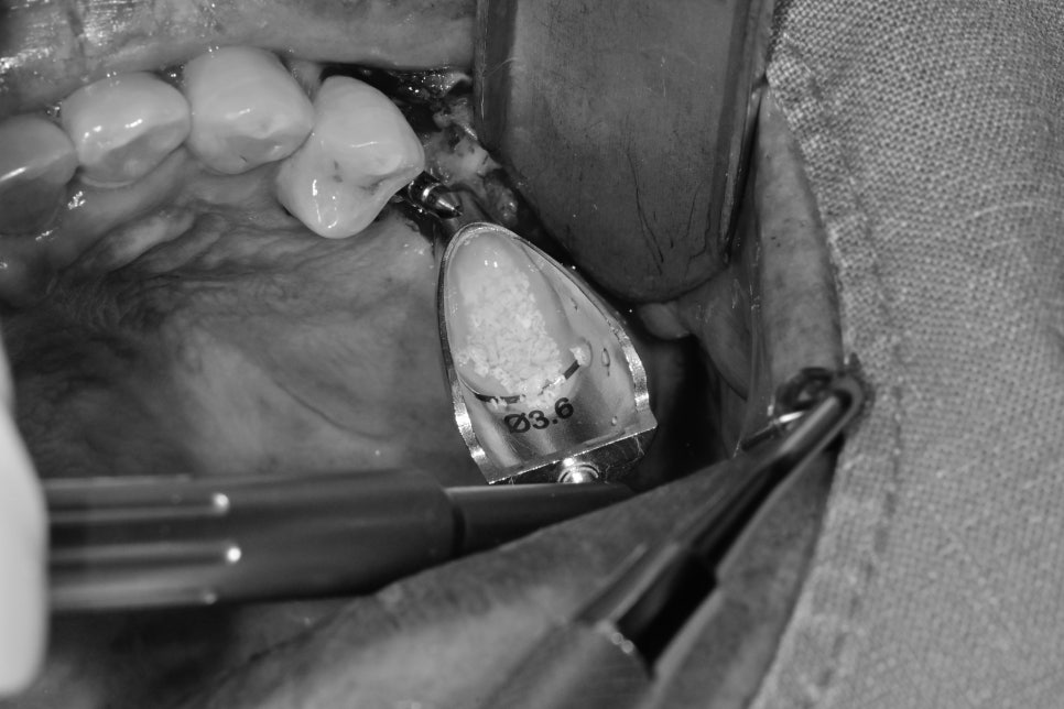 신당역 임플란트 풍치, 심한 치주염인 경우 치과에서 치료 순서 관련 이미지 6