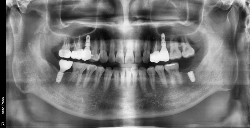 장충동 주변 치과 오래된 충치, 빠진 치아 부위 치료 방법 관련 이미지 5