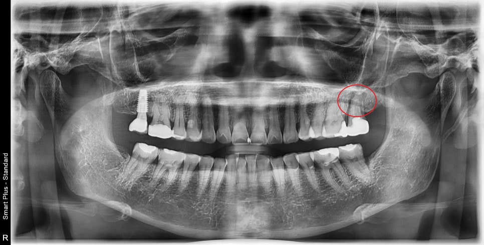 약수역 치과, 신경치료된 치아 뿌리 주변 염증이 생겼을 때 발치 후 발치와 보존술 처치( 임플란트 식립을 위한 치료 ) 관련 이미지 1