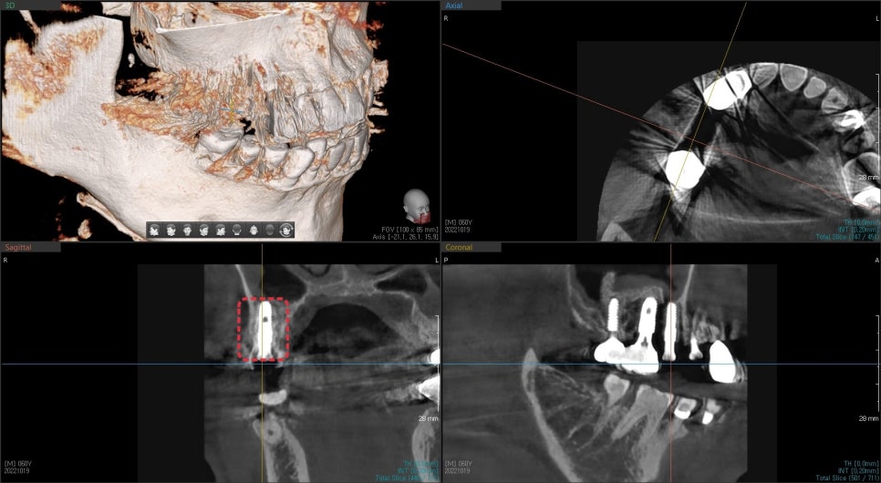 금호동 치과 신경치료된 치아 주변 염증 방치하면 안 되는 이유(발치후 임플란트) 관련 이미지 9
