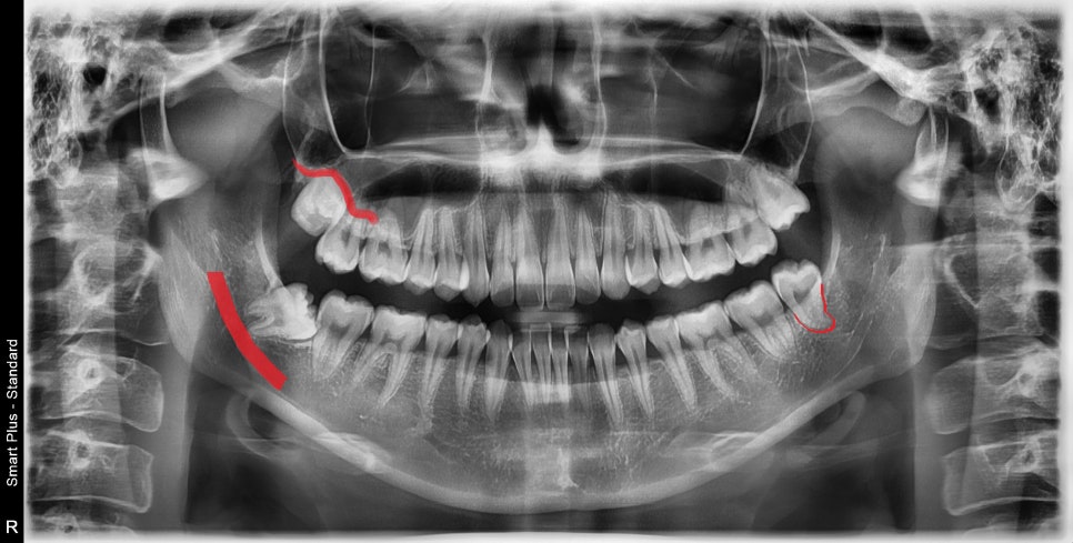 신당동 치과, 사랑니는 꼭 빼야 하나요?? 매복 사랑니 발치 시 유의할 점? (발치 후 통증 및 붓기) 관련 이미지 1