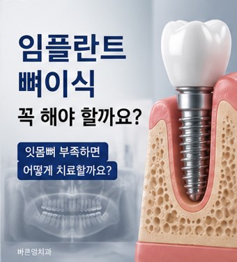 약수역 임플란트, 뼈이식 없이 가능한 경우도 있을까요? 관련 이미지 1