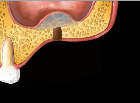 신당동 치과 오래전 빠진 치아 상태에서 임플란트 수술(상악동 거상술) 관련 이미지 3