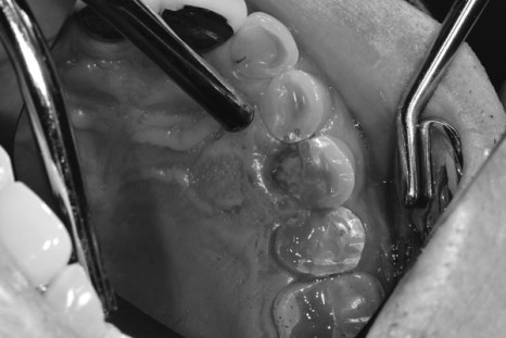 약수역 치과 크랙 치아 (금 간 치아) 관련 이미지 3